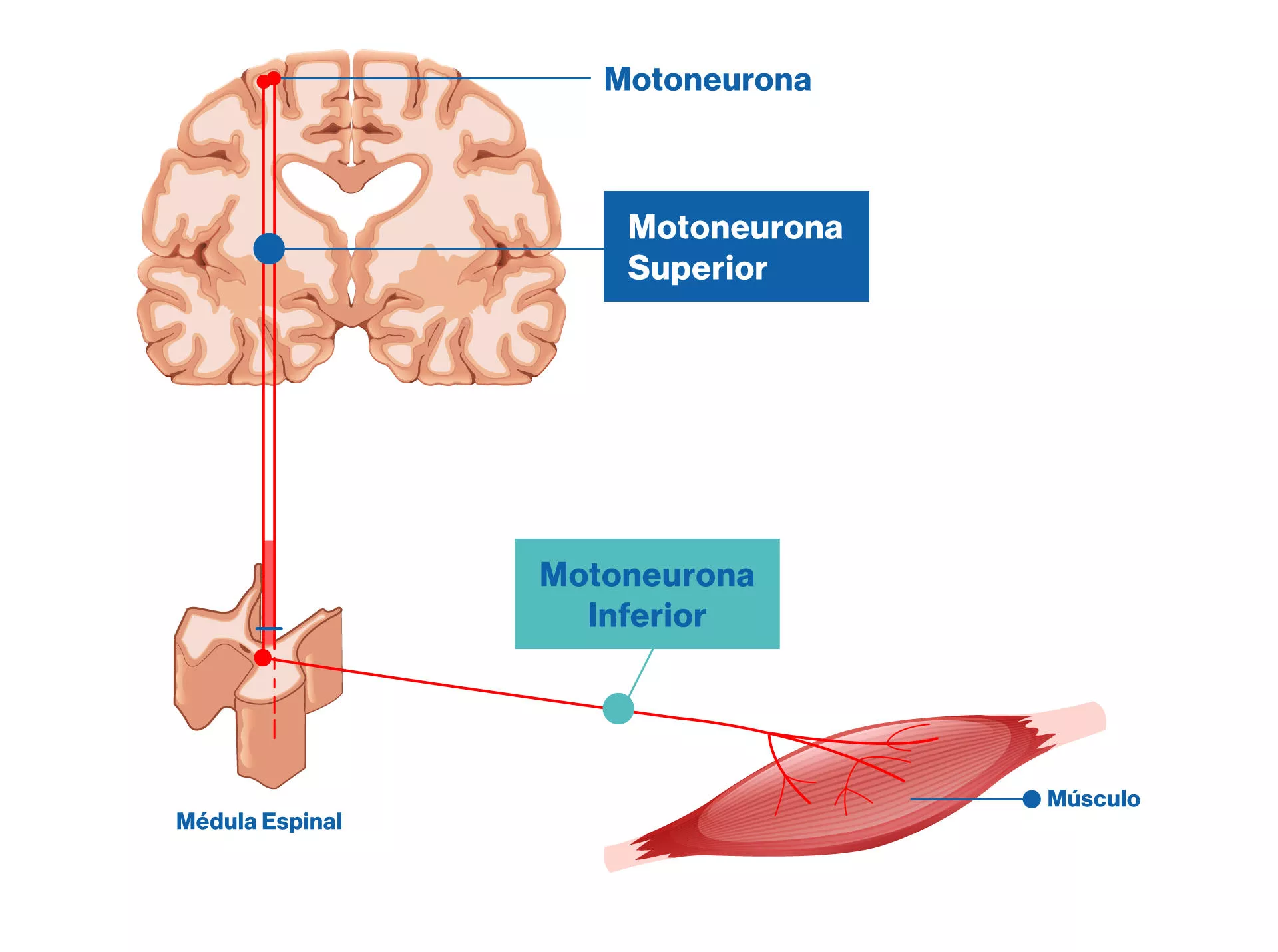Atrofia Muscular Espinal