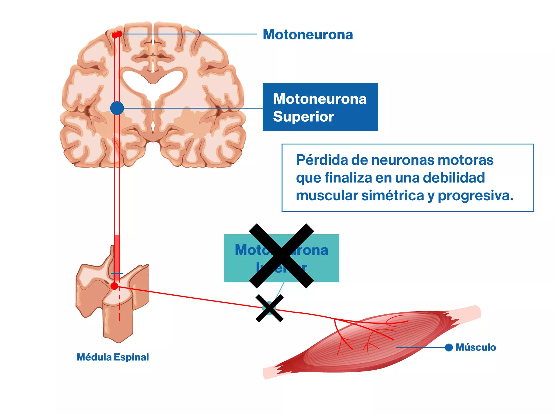 Atrofia Muscular Espinal
