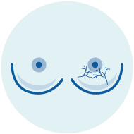 icono 8 cancer de mama sintomas