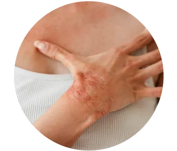 Imagen ilustrativa Placas rojizas en la piel cubiertas con escamas plateadas y gruesas.