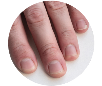 Imagen ilustrativa Uñas engrosadas, amarillentas y con hendiduras.