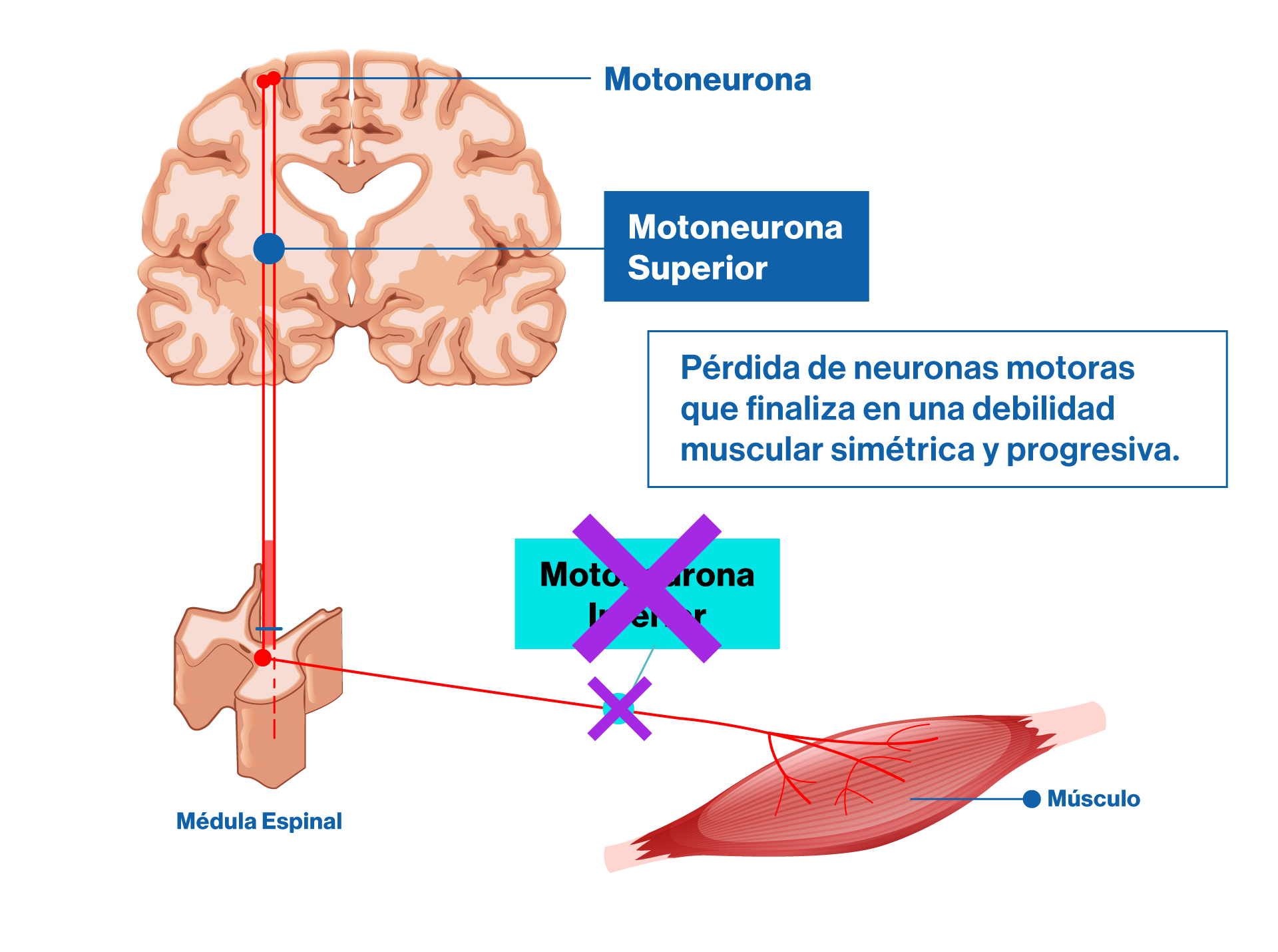 Pérdida de neuronas motoras que finaliza en una debilidad muscular simétrica y progresiva.