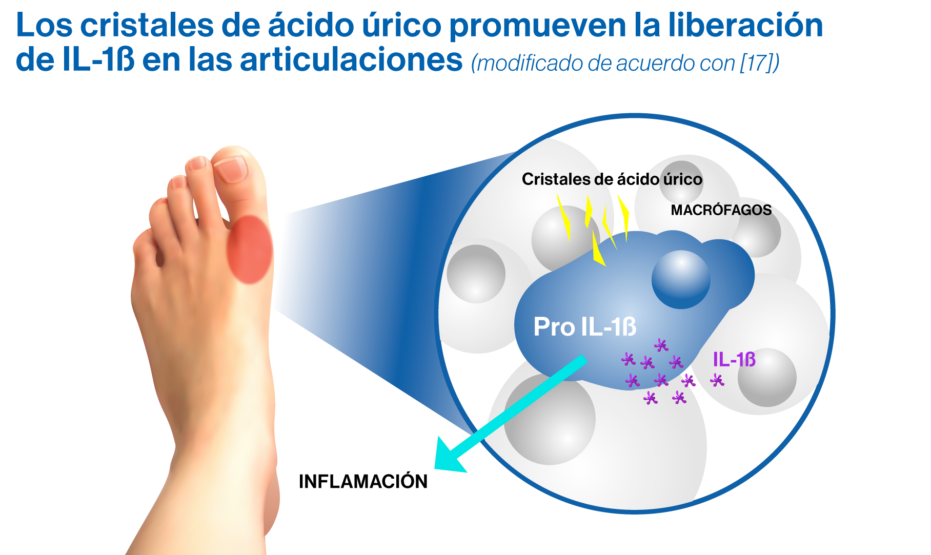 Los cristales de ácido úrico promueven la liberación de IL-1ß en las articulaciones (modificado de acuerdo con [17])
