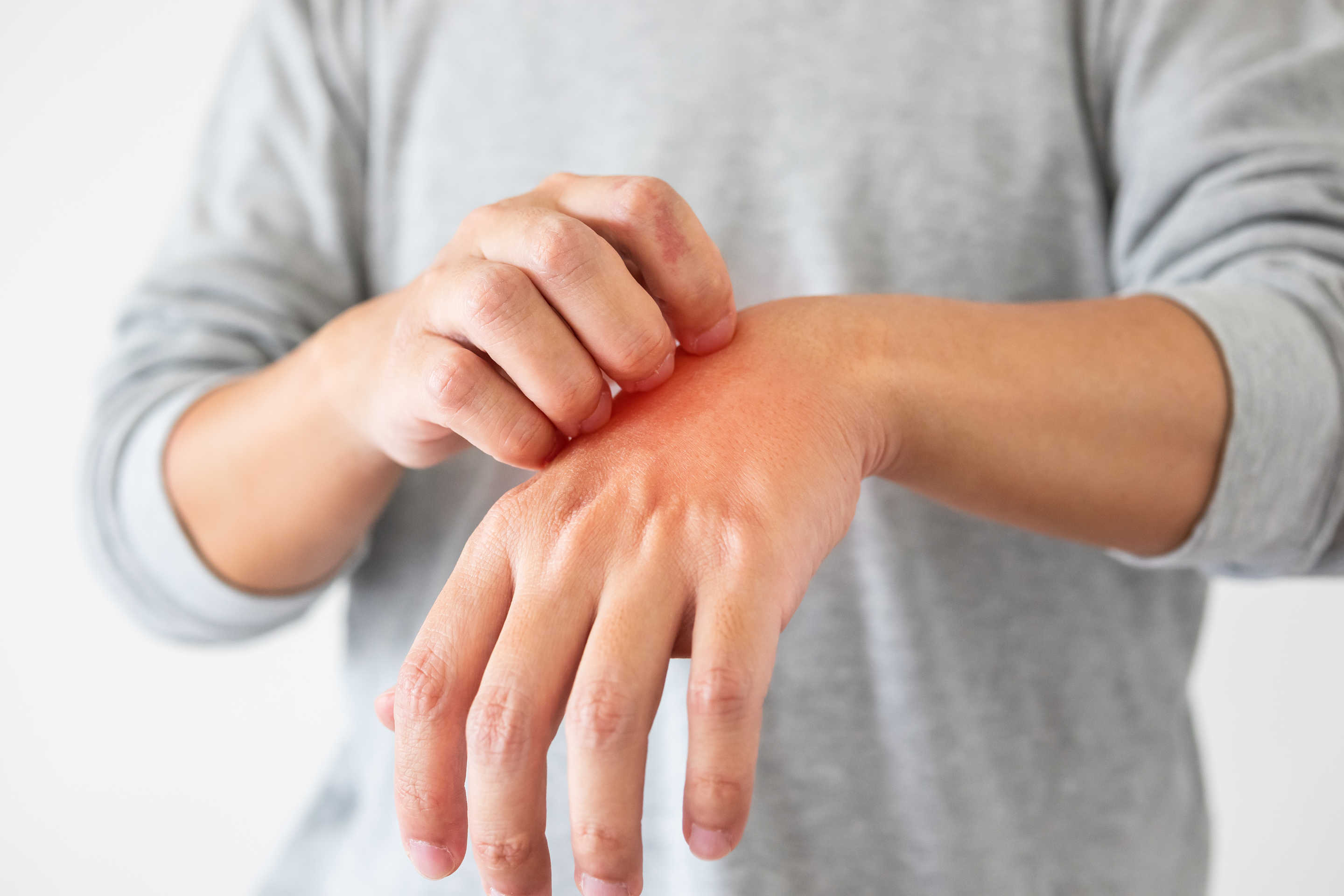 Hombre con urticaria en la mano