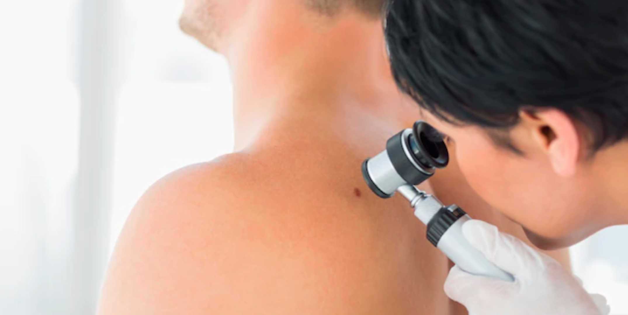 Conozca más sobre el Melanoma