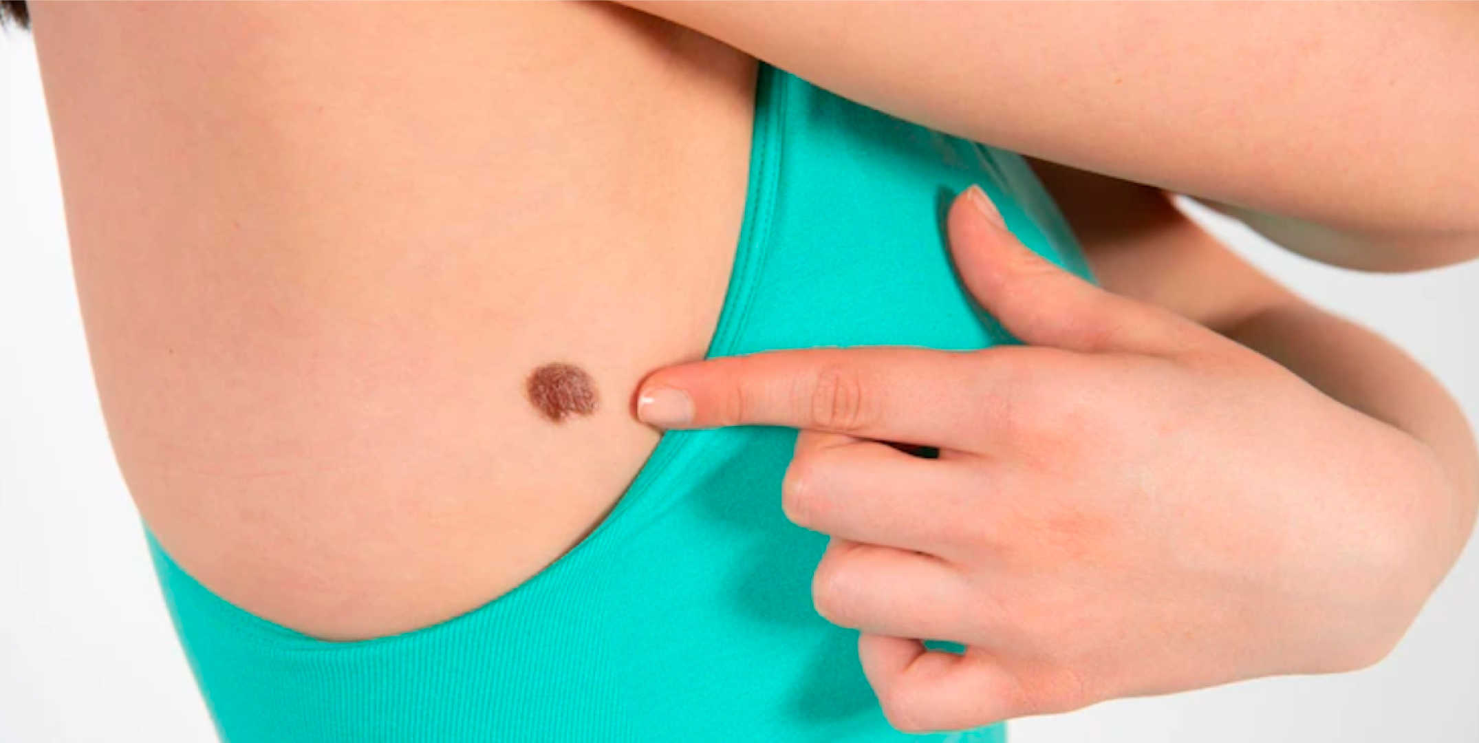 Sintomas del Melanoma