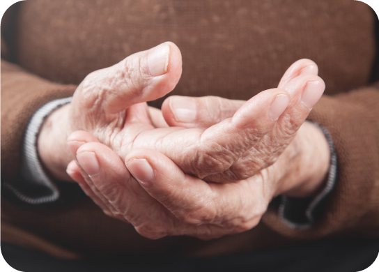 Artritis Psoriásica sección Cambios en las uñas