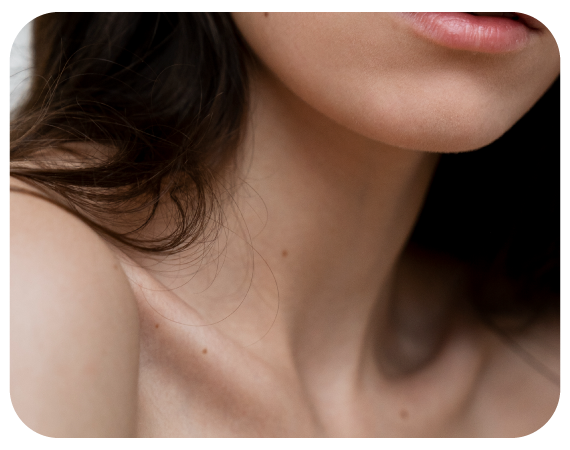 Imagen ilustrativa Hidradenitis supurativa