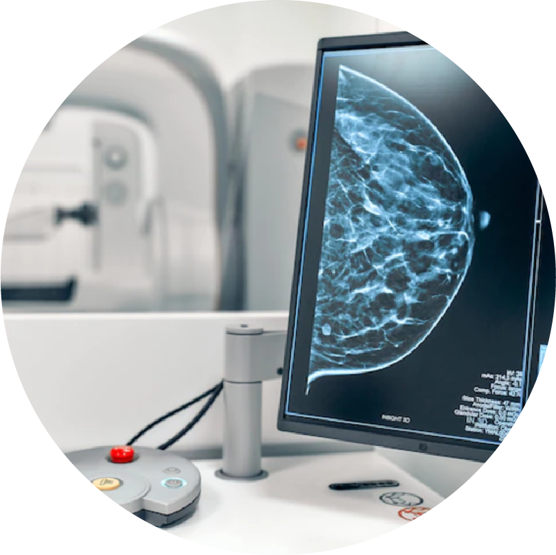 ¿El cáncer de mama se puede prevenir?