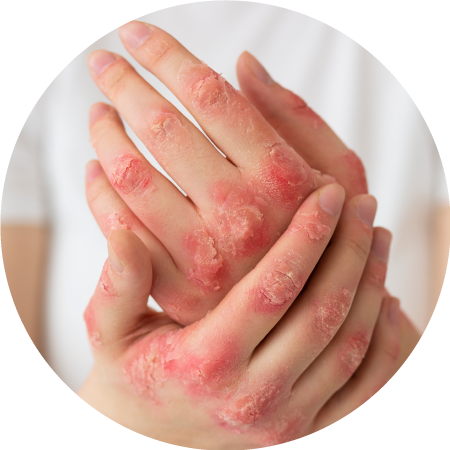 imagen ilustrativa artritis psoriasica y psoriasis ungueal