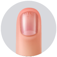 Crumbling (fragilidad y desintegración de la lámina ungeal).