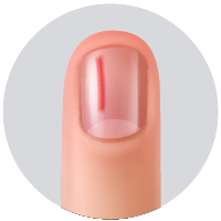 Cuando se afecta el lecho ungeal, generalmente aparecen las “hemorragias  en astilla” que son áreas lineales de hemorragia visibles a través de la uña.