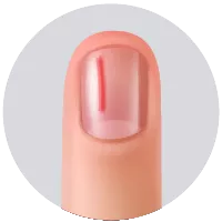 Cuando se afecta el lecho ungeal, generalmente aparecen las “hemorragias  en astilla” que son áreas lineales de hemorragia visibles a través de la uña.