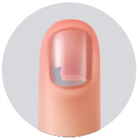 También puede ocurrir hiperqueratosis subungeal, que es la acumulación  de queratina blanco-grisácea entre el lecho y la lámina ungeal.