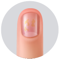 Pueden aparecer manchas en el lecho ungeal, de coloración amarillenta  o asalmonada, conocidas como “manchas de aceite”.