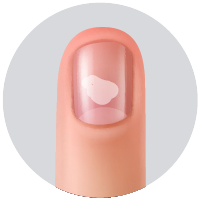 Leuconiquia(coloración blanca de la lámina ungeal).