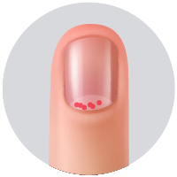 Manchas rojas en la lúnula.