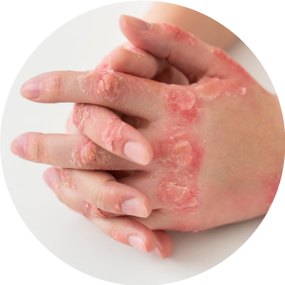 Imagen ilustrativa tratamiento tópico