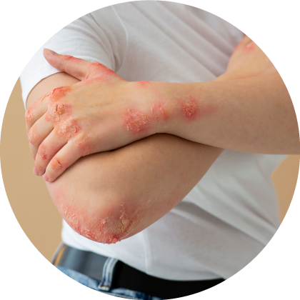 Tratamientos sistémicos psoriasis ungeal