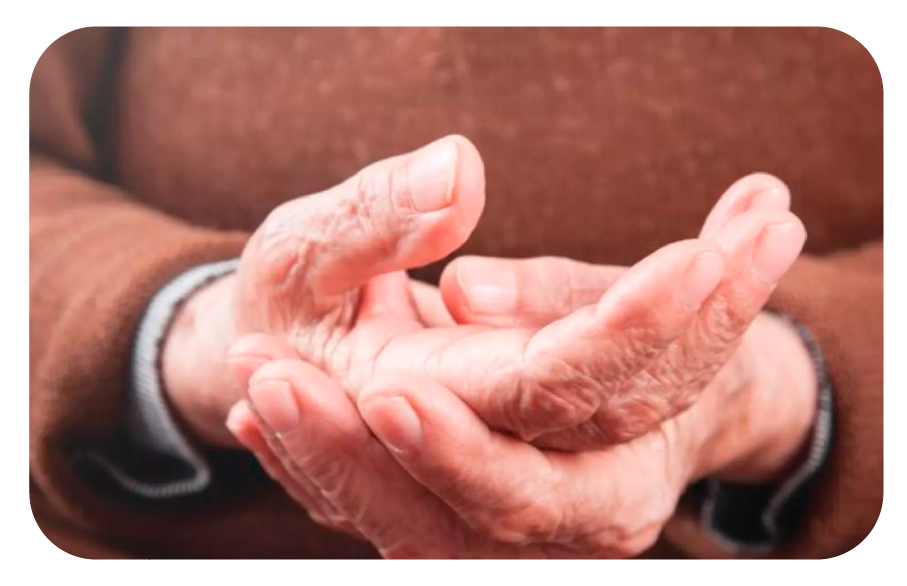 Imagen ilustrativa Artritis psoriásica y cambios en las uñas