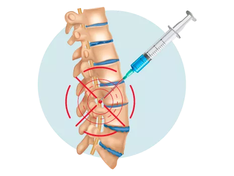 Imagen ilustrativa punción lumbar para diagnóstico de Esclerosis Múltiple