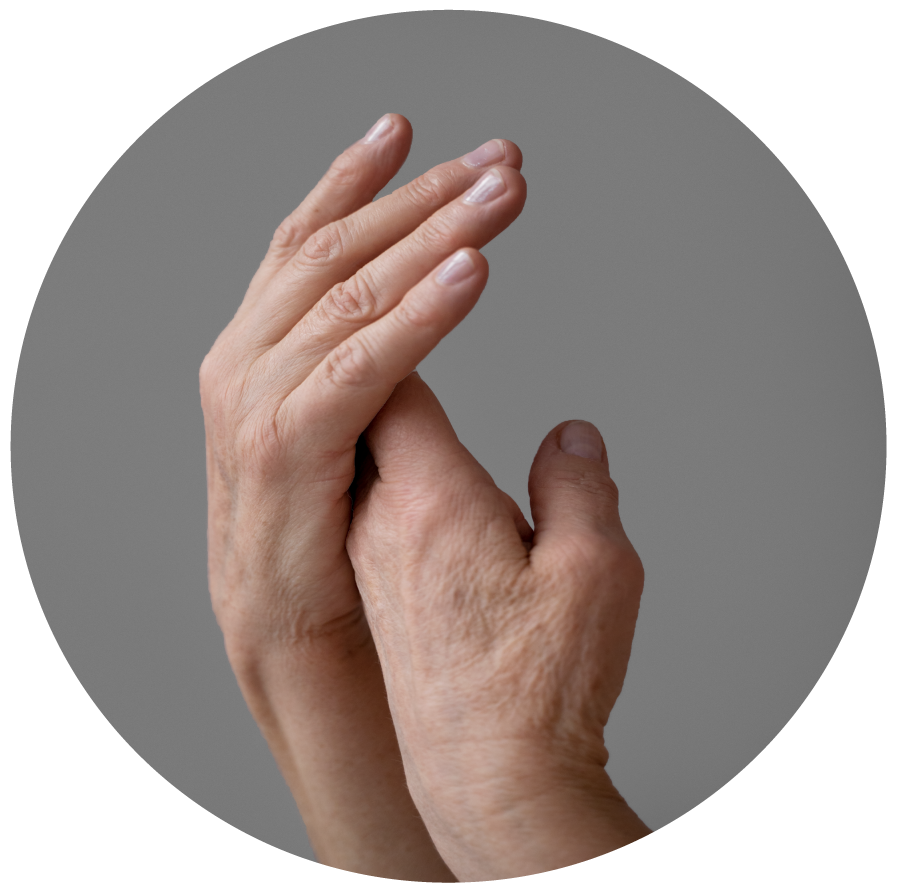 Imagen ilustrativa Artritis Psoriásica y Psoriasis ungeal