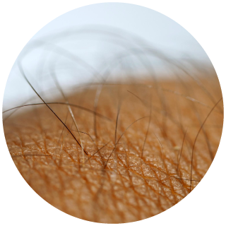 Imagen ilustrativa inflamación folicular