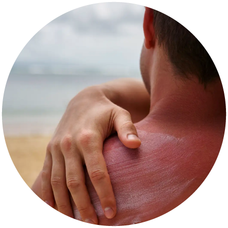 Imagen ilustrativa cuidado y protección de la piel en verano